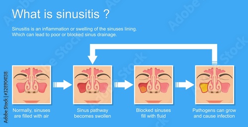 Sinusitis medical disease treat sinuses allergies surgical drug smart ENT endoscopy diagnose photo