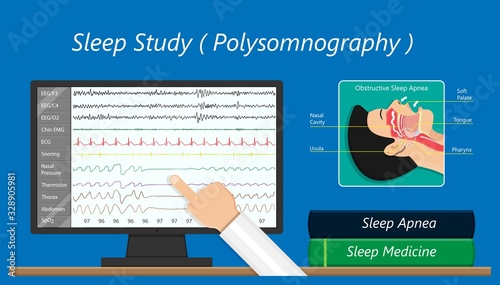 PSG sleep study test apnea diagnose Periodic limb movement disorder positive airway pressure CPAP restless leg syndrome Epworth Sleepiness Scale photo