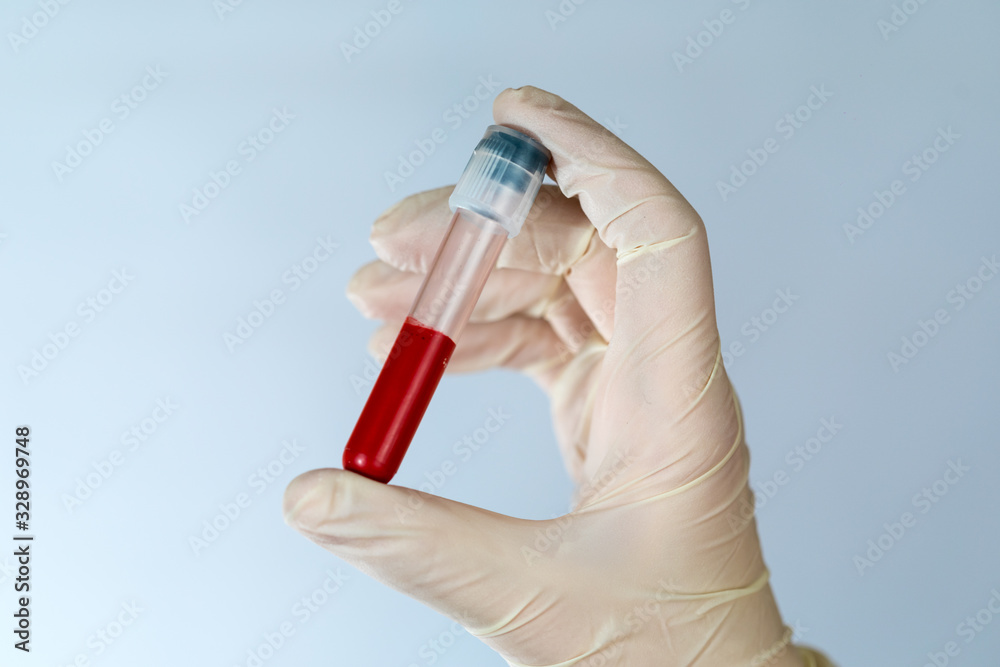 Test tube with a blood sample in the hands of a nurse. Blood test for viruses in the clinic with the observance of precautions.