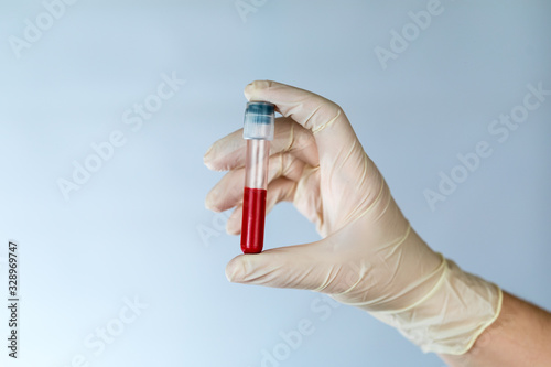 Test tube with a blood sample in the hands of a nurse. Blood test for viruses in the clinic with the observance of precautions.