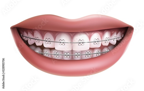 Vector isolated on white background, smile with white teeth and braces.