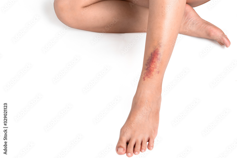 Asian women have bruise on leg from accident on white background. Asian women have bruise on leg from accident on white background.