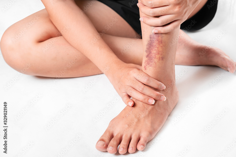 Asian women have bruise on leg from accident on white background. Asian women have bruise on leg from accident on white background.