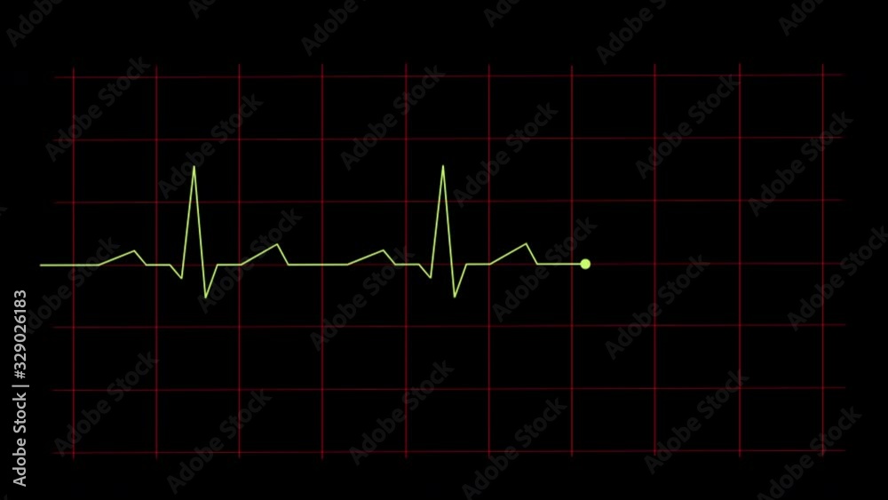 Image of an electrocardiogram on a dark monitor with a mesh. Running light pulse on a dark monitor. Animation movie electrocardiogram. Image of an electrocardiogram on a dark monitor with a mesh. Running light pulse on a dark monitor. Animation movie electrocardiogram.