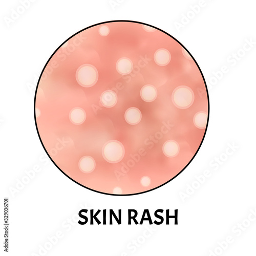 Skin rash. Symptom of dermatitis, allergies, psoriasis, eczema. Icons skin rash. Acne Infographics. Vector illustration on isolated background.