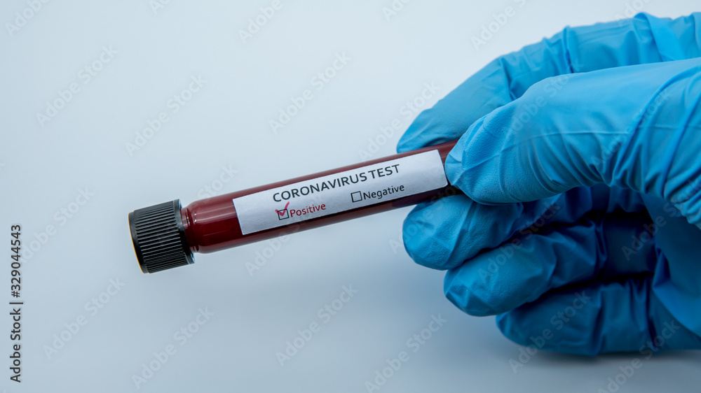 Obraz premium Positive COVID-19 test and laboratory sample blood testing for diagnosis