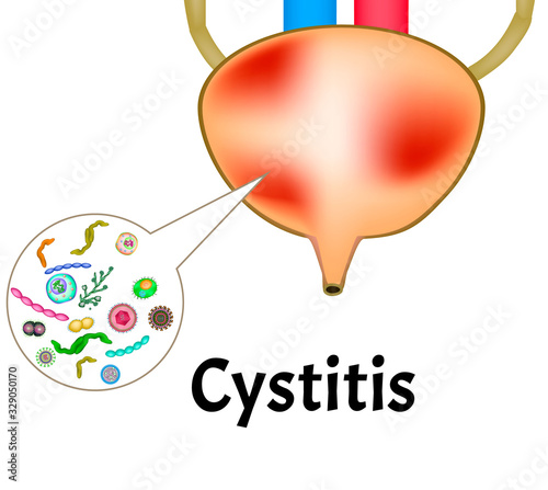 Cystitis. Inflammation of the bladder. The structure of the kidneys and bladder. Excretory system. Infographics. Vector illustration on isolated background.