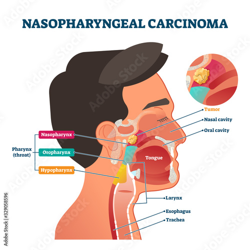 Nasopharyngeal carcinoma tumor, vector illustration photo