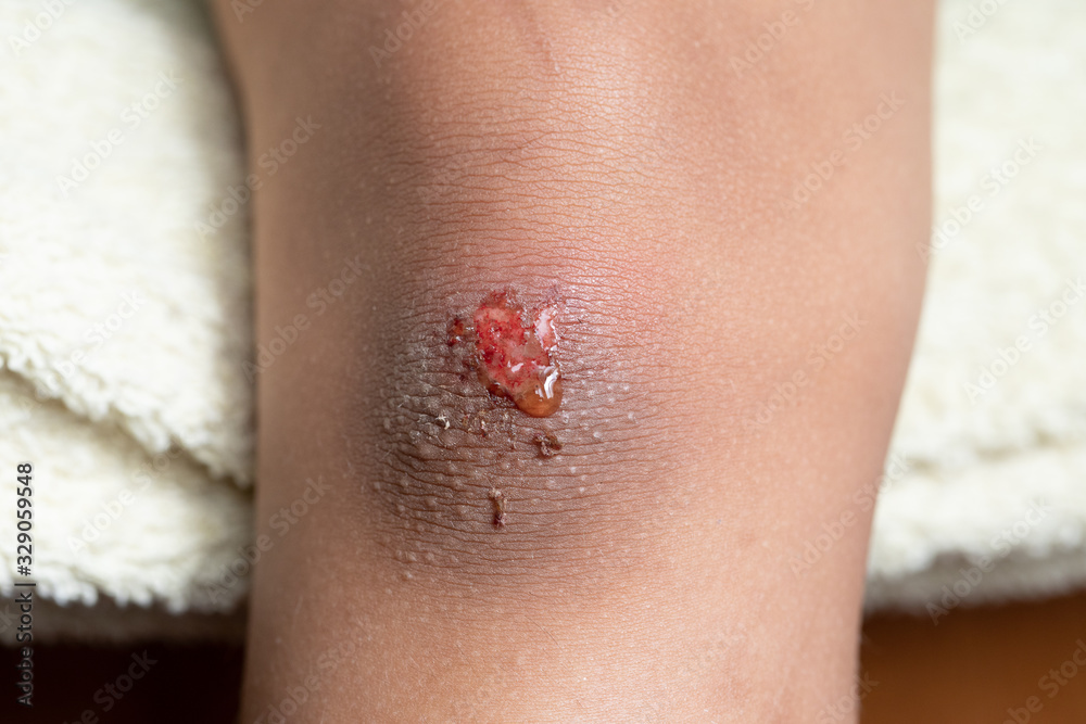 Fresh skin wound on the scraped knee of a child Fresh skin wound on the scraped knee of a child