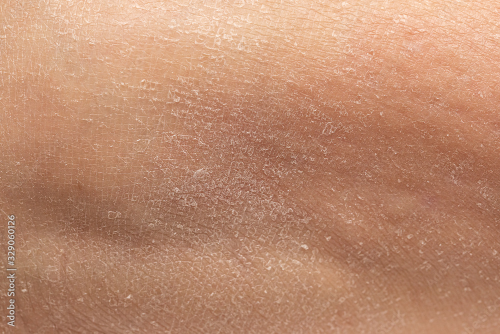 Close up detail of flaky human epidermis