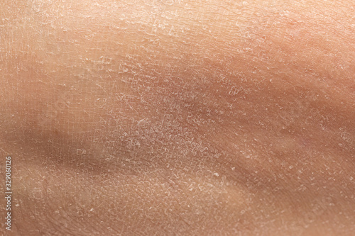 Close up detail of flaky human epidermis