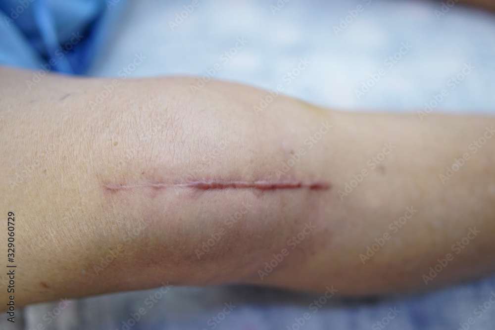 Asian senior or elderly old lady woman patient show her scars surgical total knee joint replacement Suture wound surgery arthroplasty on bed in nursing hospital ward : healthy strong medical concept. Asian senior or elderly old lady woman patient show her scars surgical total knee joint replacement Suture wound surgery arthroplasty on bed in nursing hospital ward : healthy strong medical concept.