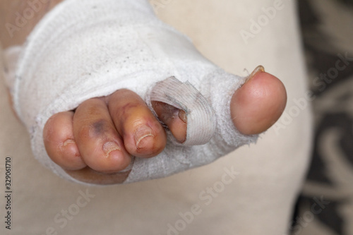 Closeup of foot bandaging post hallux valgus surgery photo