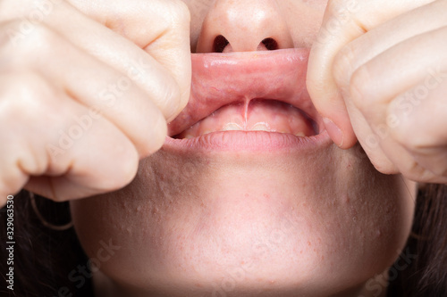Medical inspection of the superior labial frenulum to evaluate the need for frenectomy oral surgery