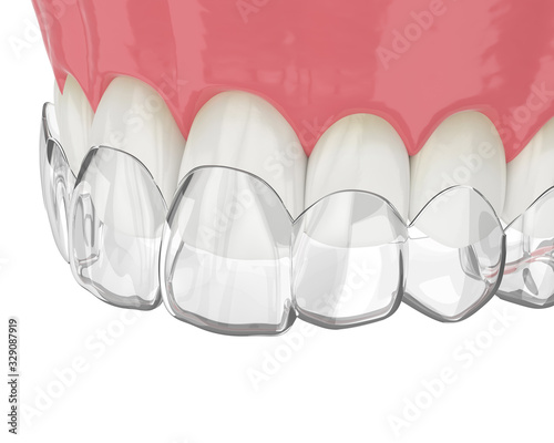 3d render of upper jaw with invisalign removable retainer photo