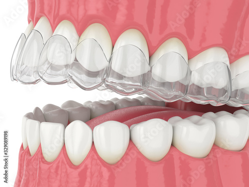 3d render of jaw with invisalign removable retainer photo