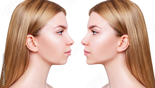 Young woman before and after chin correction.