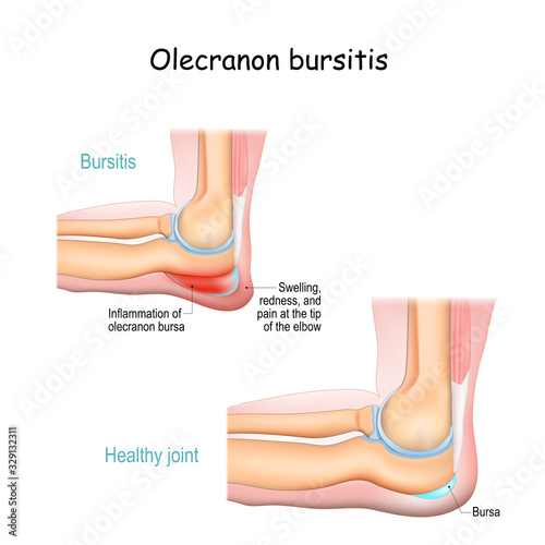 Olecranon bursitis. student elbow