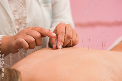 Acupuncture in session with specialized professional