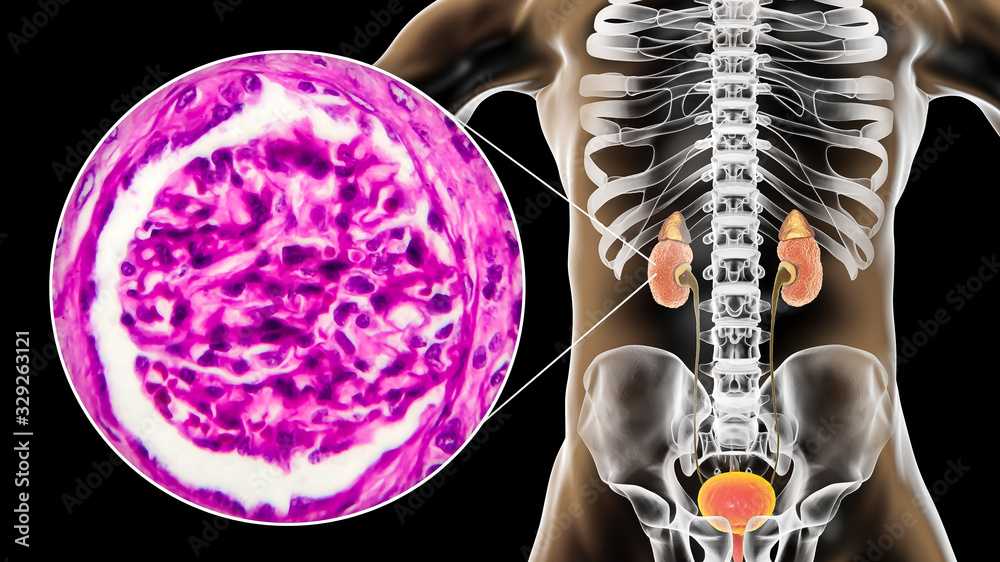 Chronic glomerulonephritis, 3D illustration showing pale contracted
