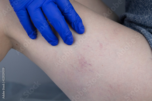 Quadro su tela A vascular surgeon examines a leg with varicose veins