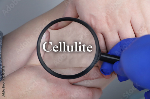 A doctor examines a patient’s leg with lipodystrophy. A magnifying glass shows cellulite. The concept of obesity and treatment of liposclerosis (orange peel) photo