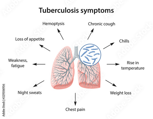 Symptoms of tuberculosis as text. Image of a lung infected with Koch's tubercle bacillus. Vector illustration in flat style isolated on white background. photo