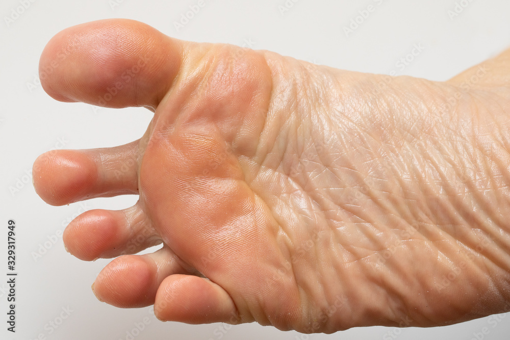 Treatment with natural oils for feet with dry skin, close-up of a female foot with freshly smeared moisturizing oil Treatment with natural oils for feet with dry skin, close-up of a female foot with freshly smeared moisturizing oil