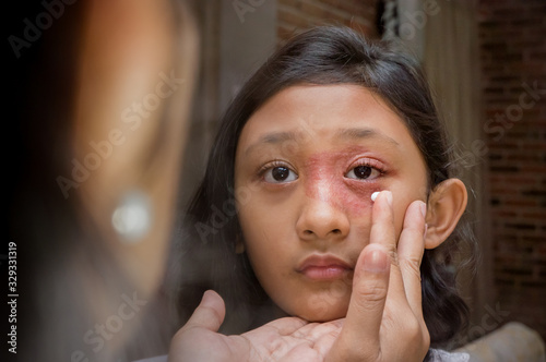 Southeast Asian ethnicity teenage girl with circular shape skin rash on her face, being applied Antifungal cream for medication by her mother. Tinea Corporis dermatitis skin treatment photo