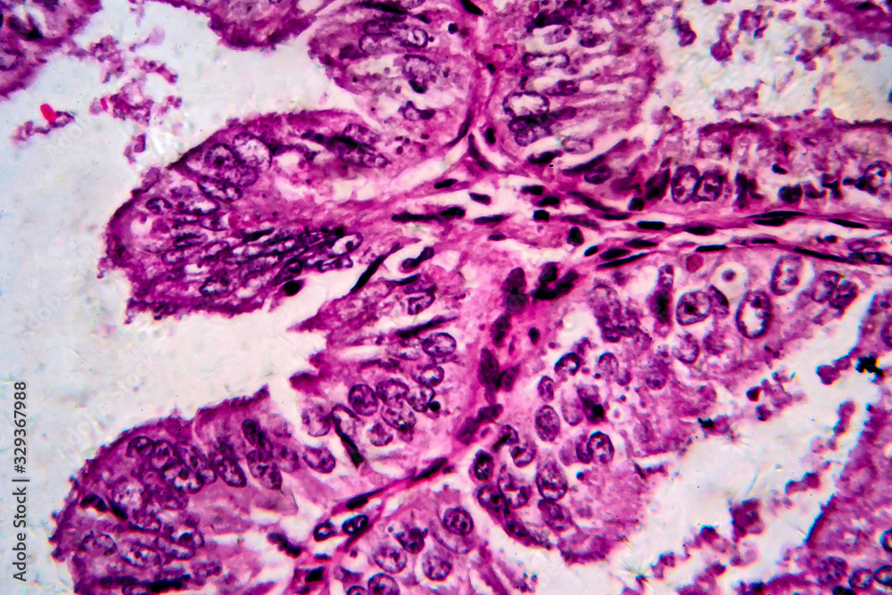 Endometrial adenocarcinoma, light micrograph, photo under microscope Endometrial adenocarcinoma, light micrograph, photo under microscope