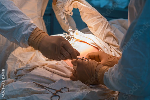 close-up hands of pediatric surgeons perform surgery using laparoscopic ports for endoscopic surgery. In a sterile operating room. Pediatric surgery, treatment of inguinal hernia in children by PIRS photo