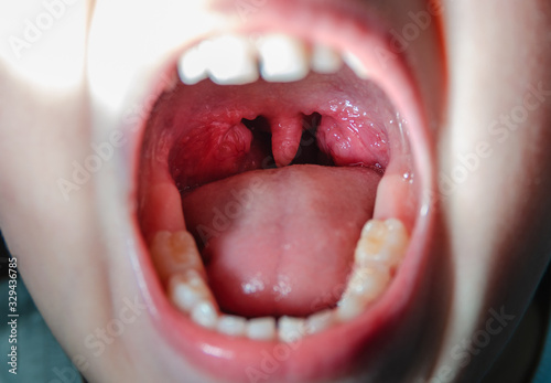 Colds open mouth with red, inflamed glands photo