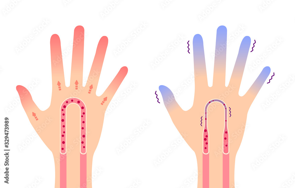 Comparison illustration of normal hand and cold hand ( sensitivity to