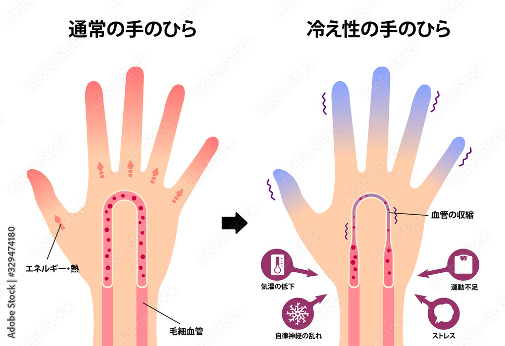 通常の手と末端冷え性の手 比較イラスト 冷え性の原因 Stock Vector Adobe Stock