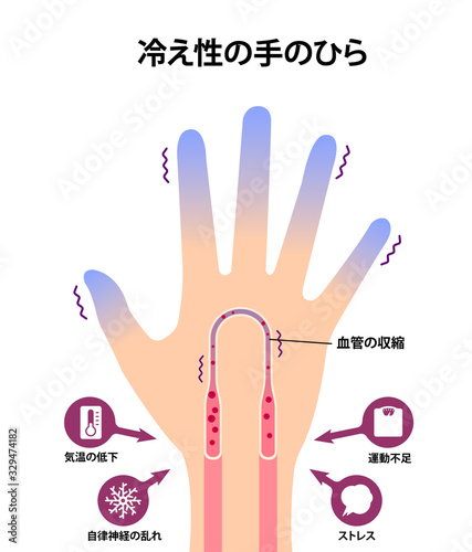 末端冷え性の手 イラスト (冷え性の原因) 