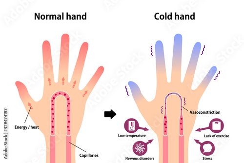 Fototapeta Naklejka Na Ścianę i Meble -  Comparison illustration of normal hand and cold hand ( sensitivity to cold, cold fingertips)