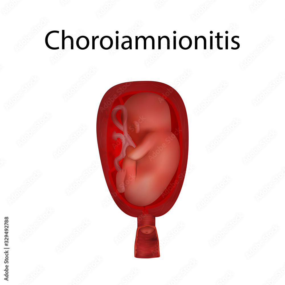 Choroiamnionitis. Infection, infected. Fetus in uterus, womb, placenta ...