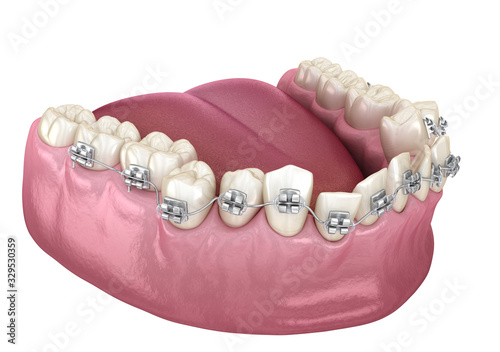 Abnormal teeth position and Clear braces tretament. Medically accurate dental 3D illustration photo