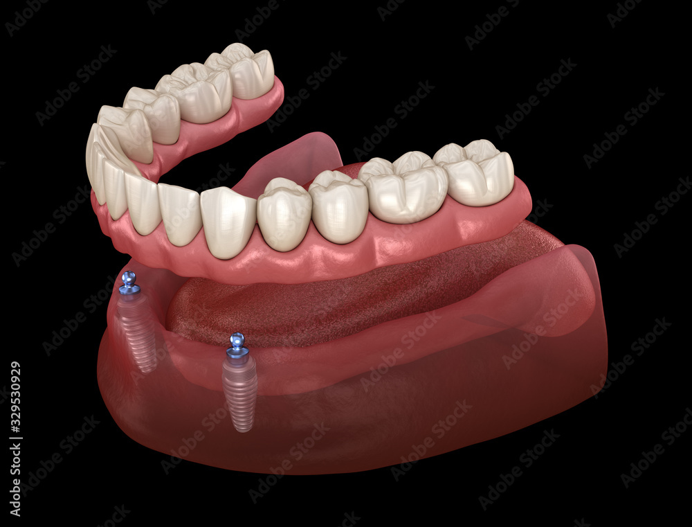 Mandibular removable prosthesis All on 2 system supported by implants with ball attachments. Medically accurate dental 3D illustration Mandibular removable prosthesis All on 2 system supported by implants with ball attachments. Medically accurate dental 3D illustration