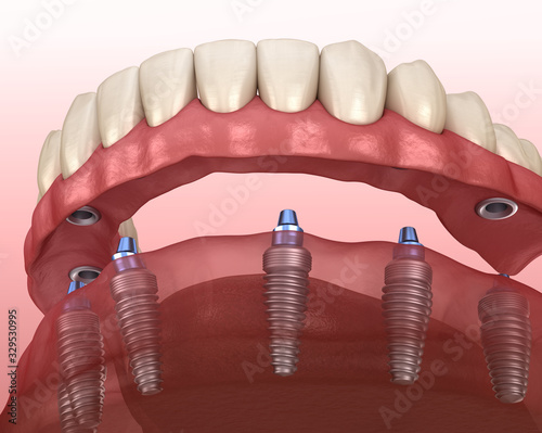 Mandibular prosthesis with gum All on 6 system supported by implants. Medically accurate 3D illustration of human teeth and dentures concept