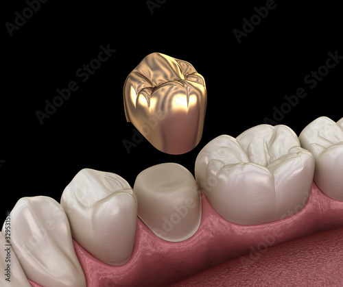 Fototapeta Naklejka Na Ścianę i Meble -  Golden crown premolar tooth assembly process. Medically accurate 3D illustration of human teeth treatment