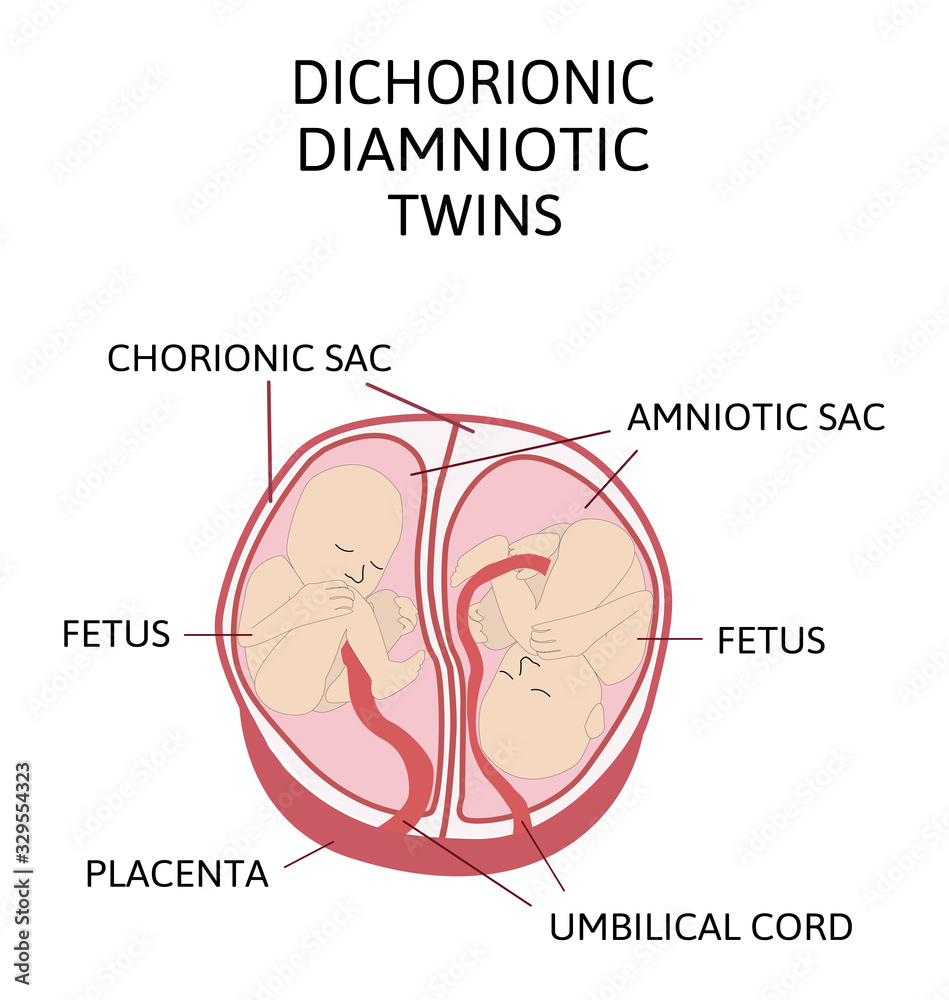 Obraz premium Anatomy of abdomen with twins. Twin types infographic elements in flat design. Monozygotic or Dizygotic Placentation of twins medical