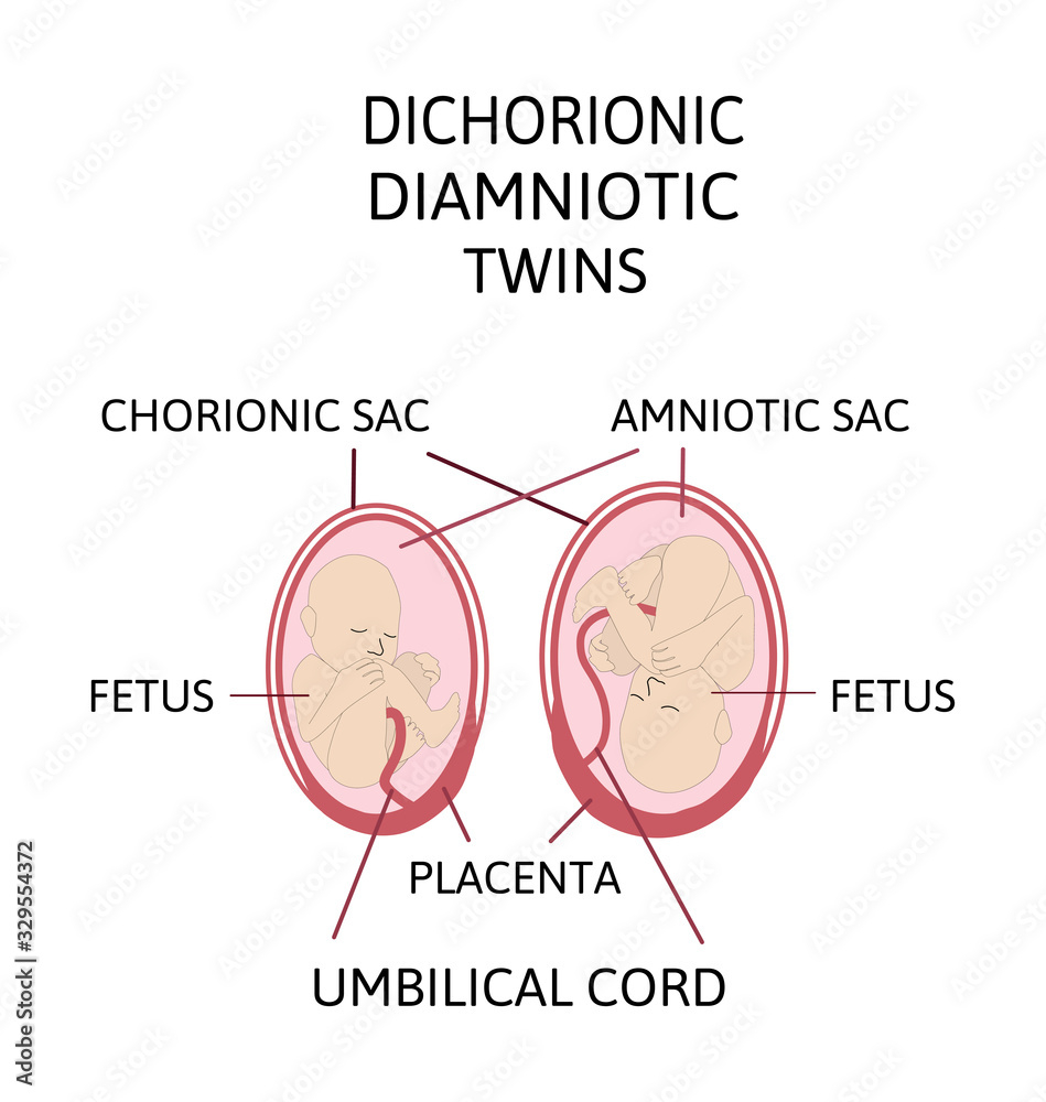 Fototapeta premium Anatomy of abdomen with twins. Twin types infographic elements in flat design. Monozygotic or Dizygotic Placentation of twins medical