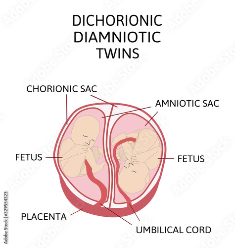 Anatomy of abdomen with twins. Twin types infographic elements in flat design. Monozygotic or Dizygotic Placentation of twins medical
