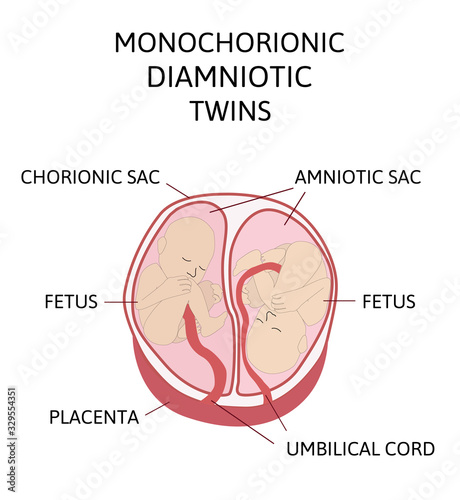 Anatomy of abdomen with twins. Twin types infographic elements in flat design. Monozygotic or Dizygotic Placentation of twins medical