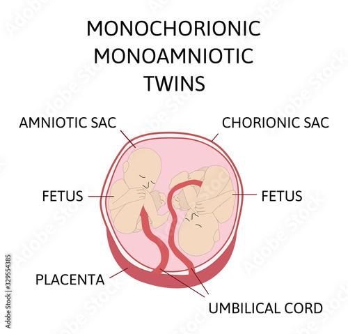 Anatomy of abdomen with twins. Twin types infographic elements in flat design. Monozygotic or Dizygotic Placentation of twins medical