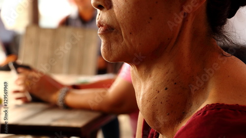 Goiter and old woman