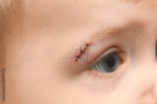 Wound on the eyebrow of a kid after a bruise