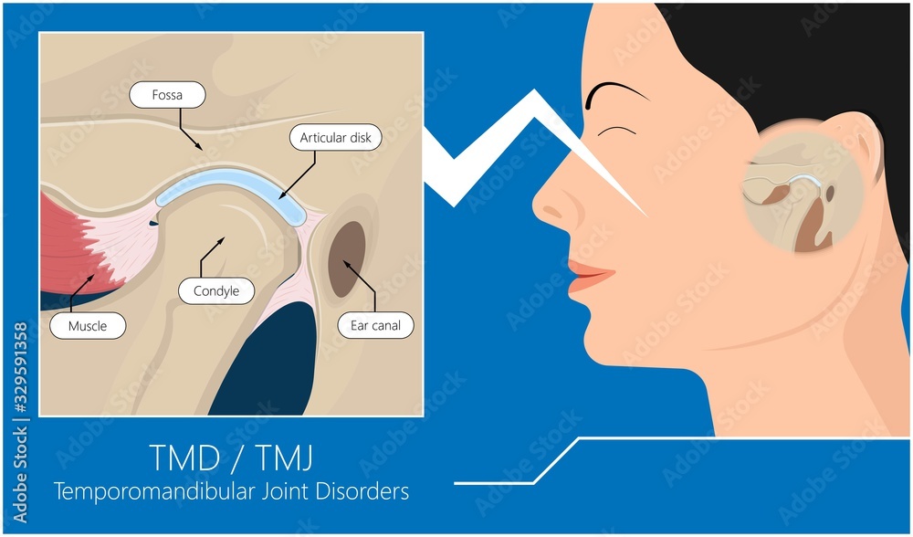 Temporomandibular Joint Disorders TMD TMJ treat pain displaced disc temporal bone locking bite