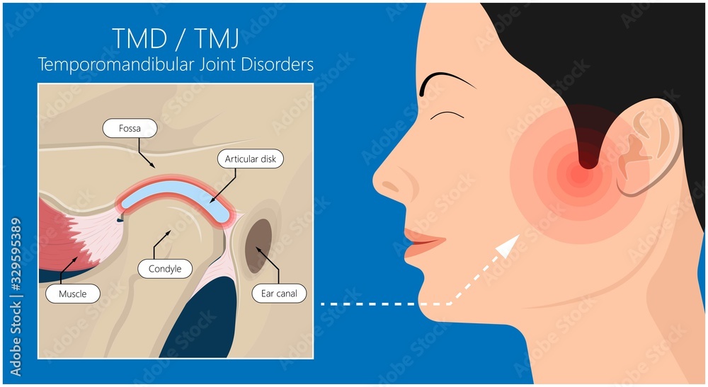 Vettoriale Stock Temporomandibular Joint Disorders TMD TMJ treat pain displaced disc temporal